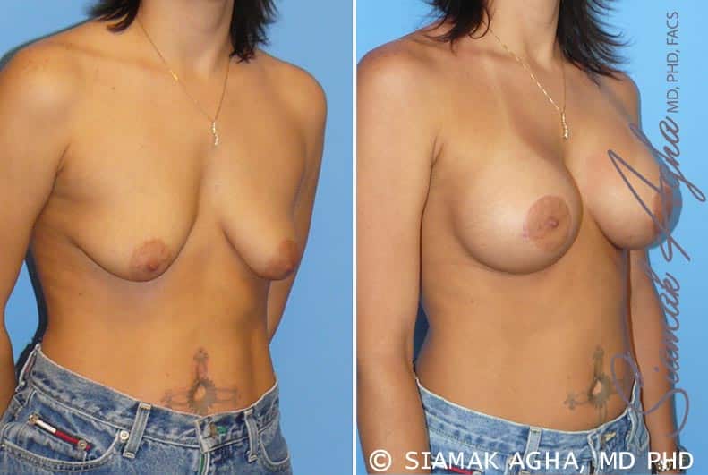 orange county breast lift with augmentation patient 5 front right Newport Beach, CA