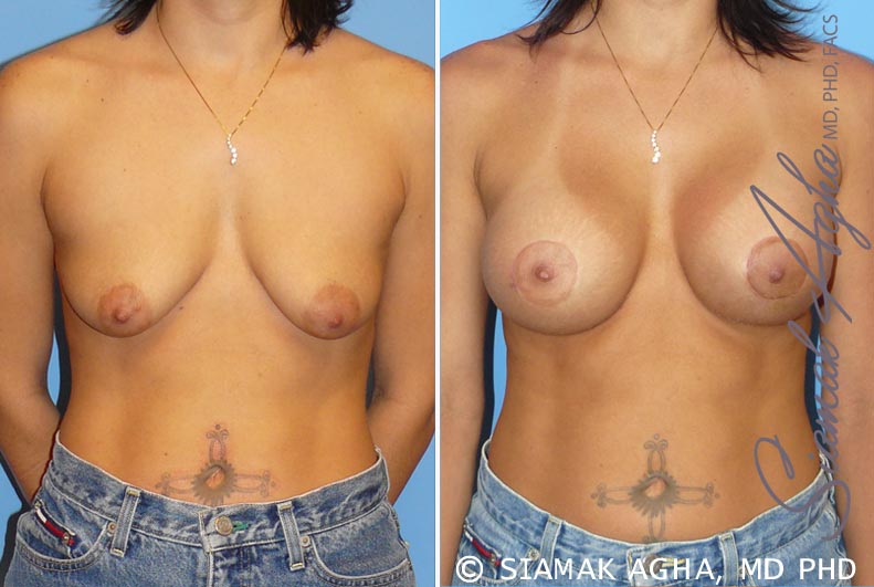 Breast Lift with Augmentation Patient 5