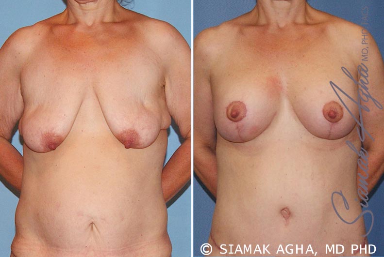orange county breast lift with augmentation patient 6 front Newport Beach, CA