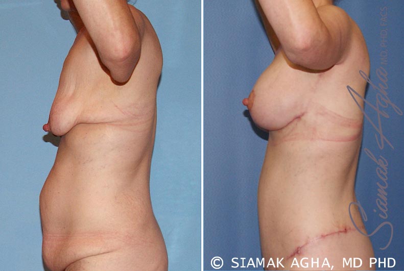 Breast Lift with Augmentation Patient 6