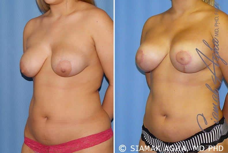 orange county breast lift with augmentation patient 7 front left Newport Beach, CA
