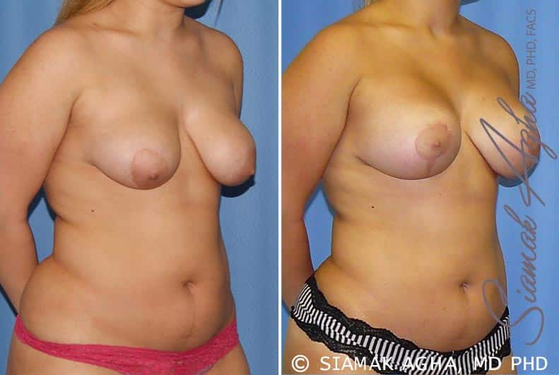 orange county breast lift with augmentation patient 7 front right Newport Beach, CA