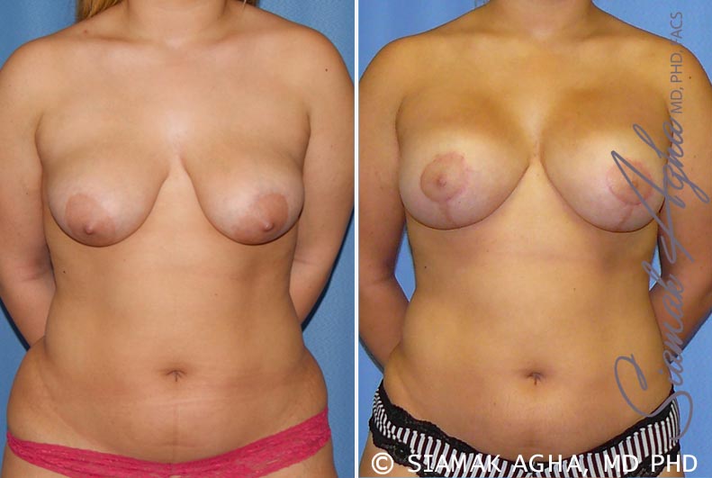 orange county breast lift with augmentation patient 7 front Newport Beach, CA