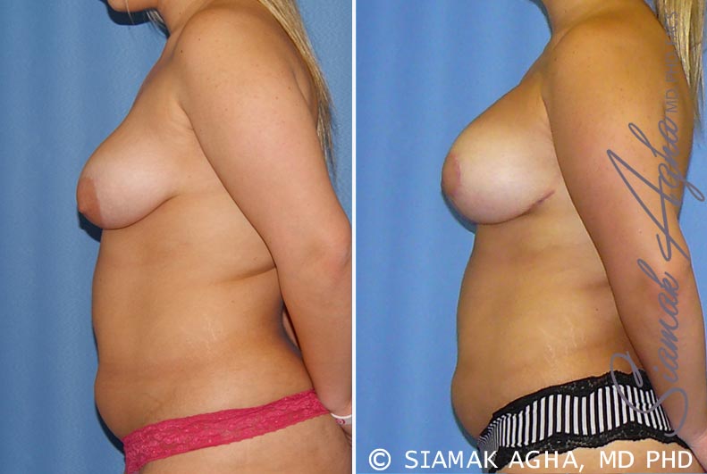 Breast Lift with Augmentation Patient 7