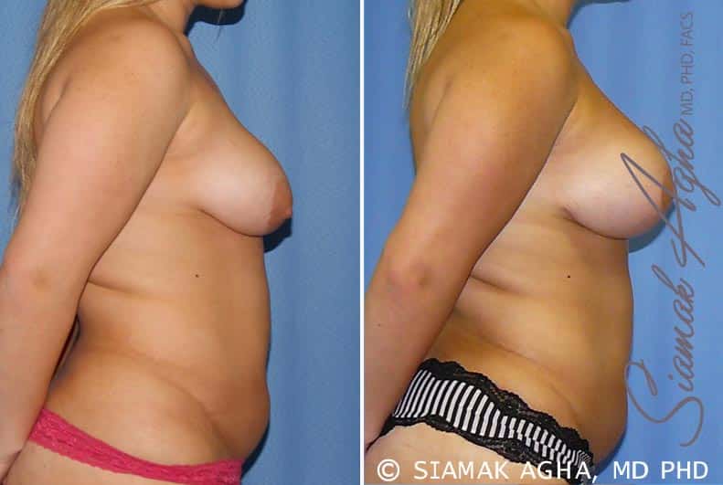 Breast Lift with Augmentation Patient 7