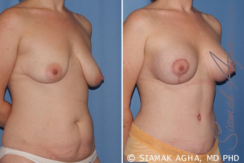orange county breast lift with augmentation patient 8 front right Newport Beach, CA
