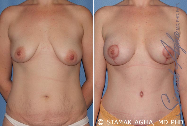 orange county breast lift with augmentation patient 8 front Newport Beach, CA