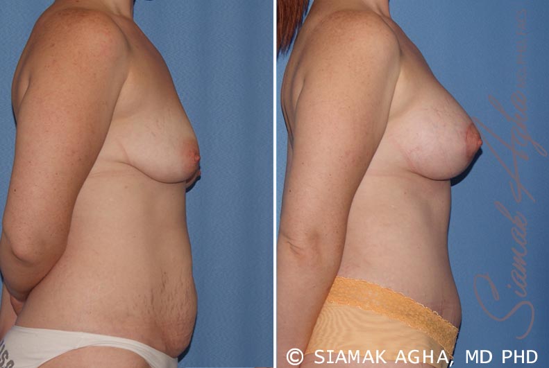 Breast Lift with Augmentation Patient 8