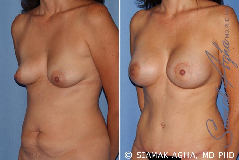 orange county breast lift with augmentation patient 9 front left Newport Beach, CA