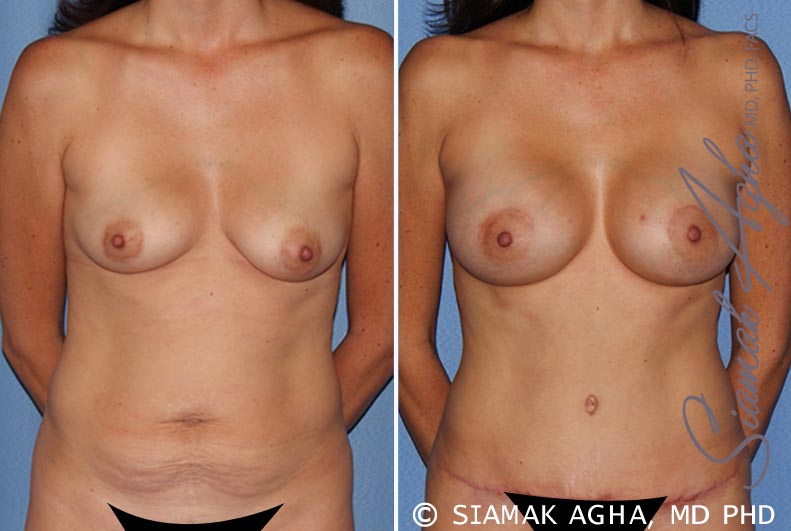 orange county breast lift with augmentation patient 9 front Newport Beach, CA