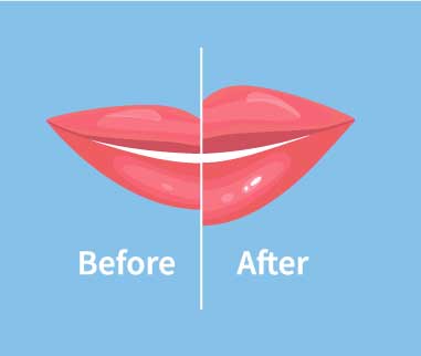 Lip Augmentation Newport Beach￼