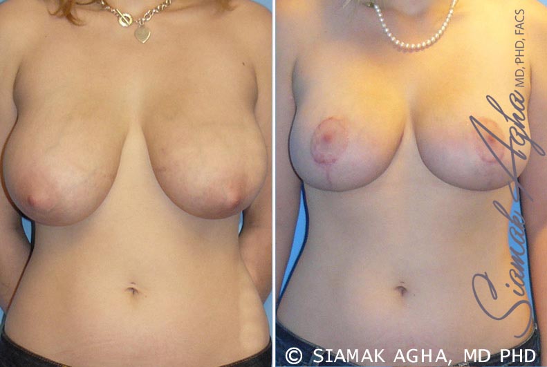 Breast Reduction Newport Beach￼
