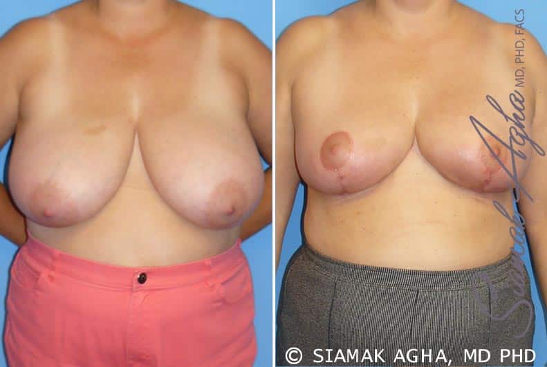 Breast Reduction Patient 3