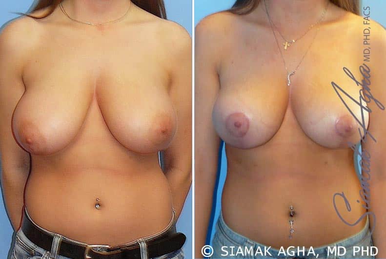 Breast Reduction Newport Beach￼