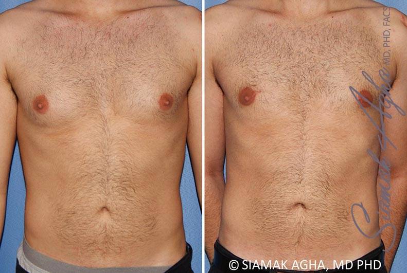 orange county male breast reduction patient 10 front Newport Beach, CA
