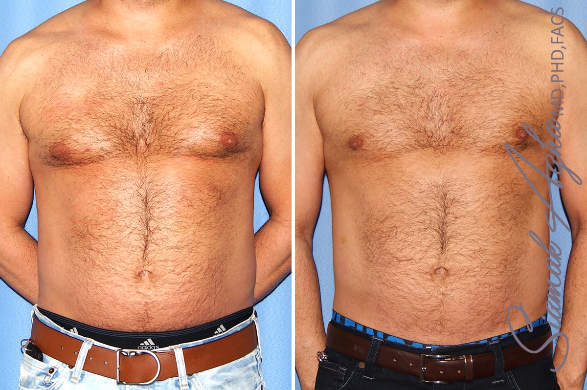 Male Breast Reduction Patient 11