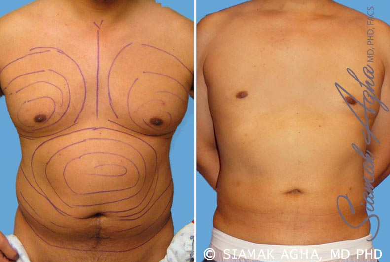 orange county male breast reduction patient 3 front Newport Beach, CA