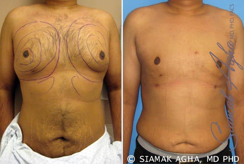 orange county male breast reduction patient 4 front Newport Beach, CA
