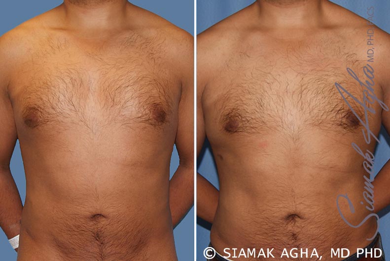 orange county male breast reduction patient 6 front Newport Beach, CA