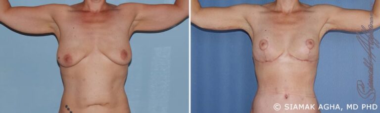 orange-country-arm-lift-patient-1-front
