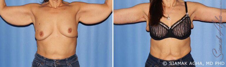 orange-county-arm-lift-patient-10-front