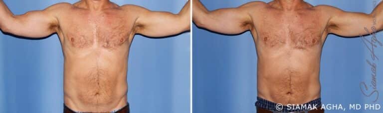 orange-county-arm-lift-patient-11-front
