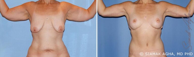 orange-county-arm-lift-patient-12-front