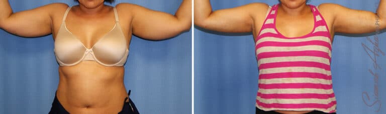 orange-county-arm-lift-patient-13-front