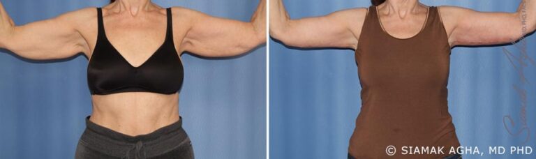 orange-county-arm-lift-patient-2-front