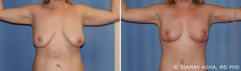 orange-county-arm-lift-patient-3-front