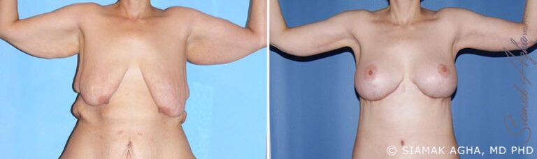 orange-county-arm-lift-patient-4-front