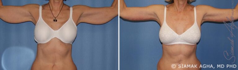 orange-county-arm-lift-patient-5-front