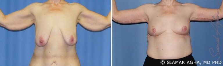 orange-county-arm-lift-patient-6-front