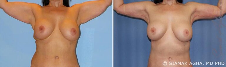 orange-county-arm-lift-patient-8-front