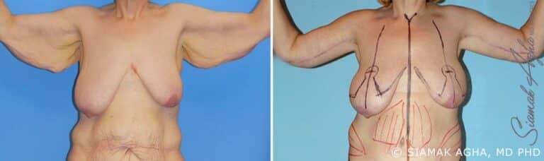 orange-county-arm-lift-patient-9-front