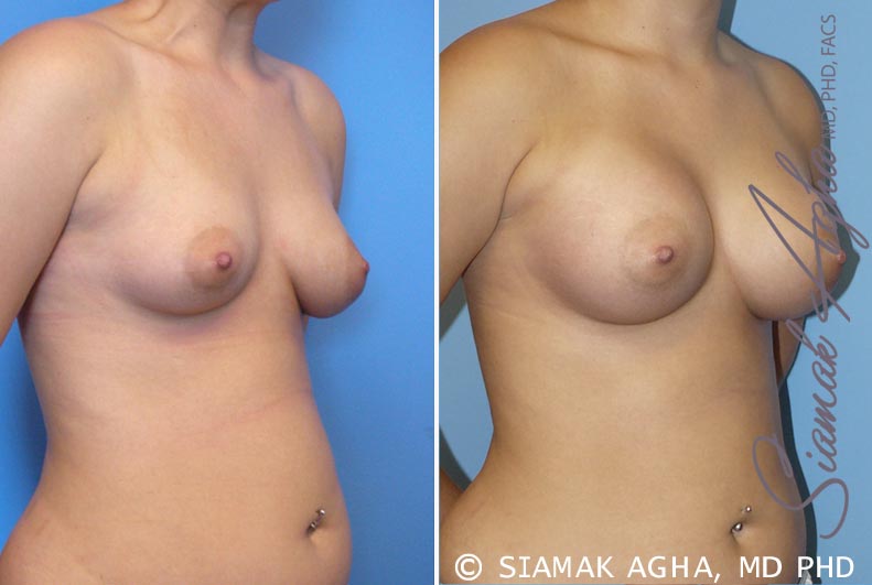 Orange County Breast Asymmetry Patient 2 Front Right Newport Beach, CA