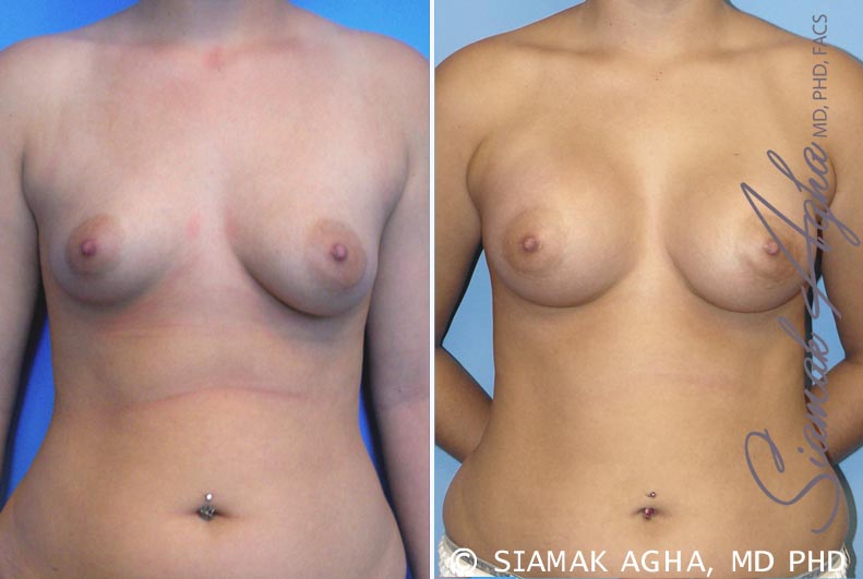 Breast Asymmetry Patient 2