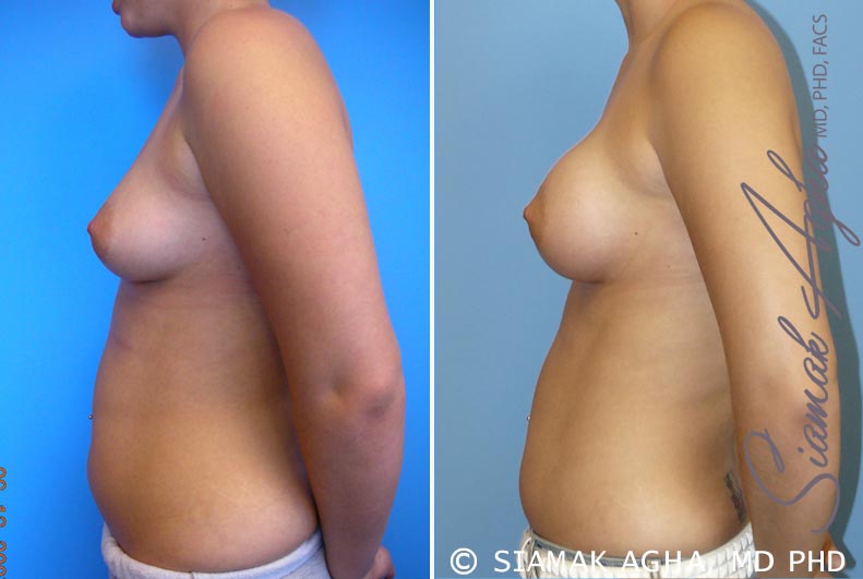 Breast Asymmetry Patient 2
