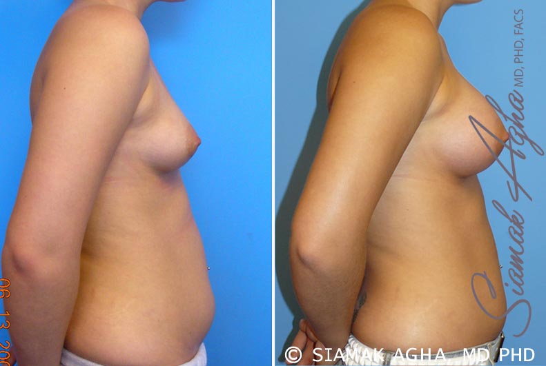 Orange County Breast Asymmetry Patient 2 Right Newport Beach, CA