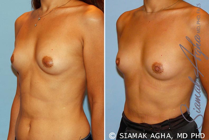 Orange County Breast Asymmetry Patient 3 Front Left Newport Beach, CA
