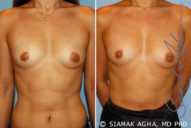 Breast Asymmetry Patient 3