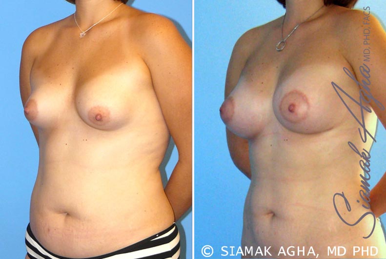 Orange County Breast Asymmetry Patient 4 Front Left Newport Beach, CA