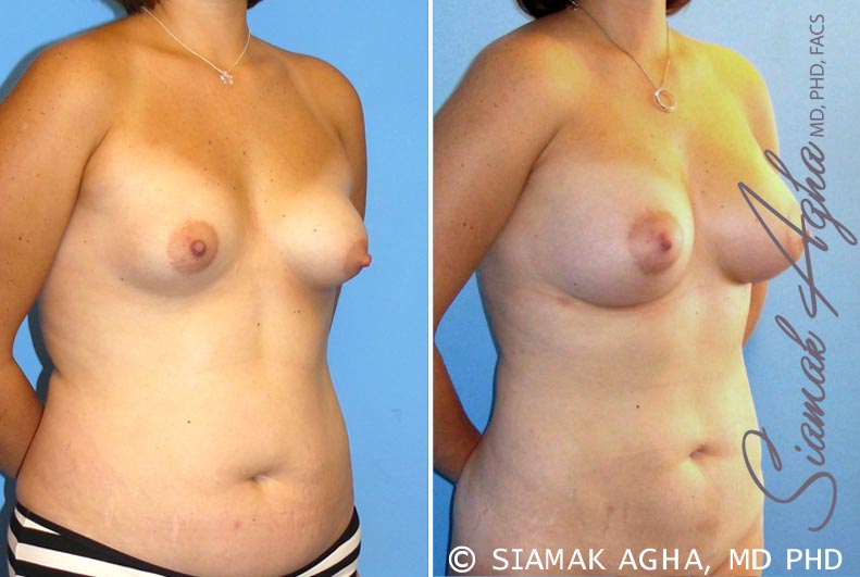 Orange County Breast Asymmetry Patient 4 Front Right Newport Beach, CA