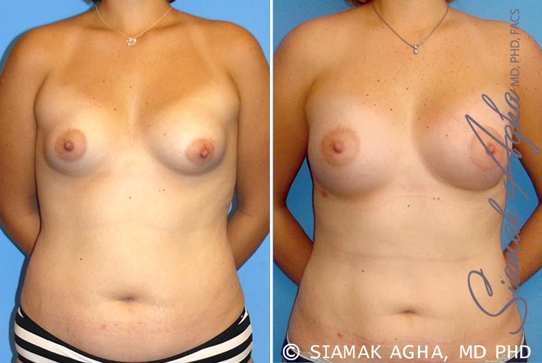 Orange County Breast Asymmetry Patient 4 Front Newport Beach, CA