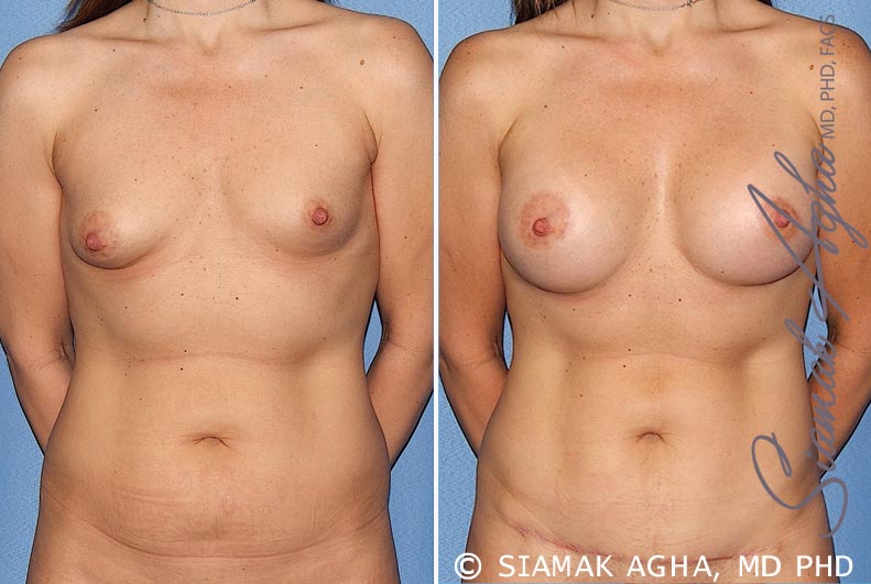 Orange County Breast Asymmetry Patient 5 Front Newport Beach, CA