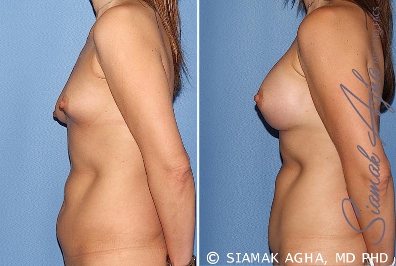 Orange County Breast Asymmetry Patient 5 Left Newport Beach, CA