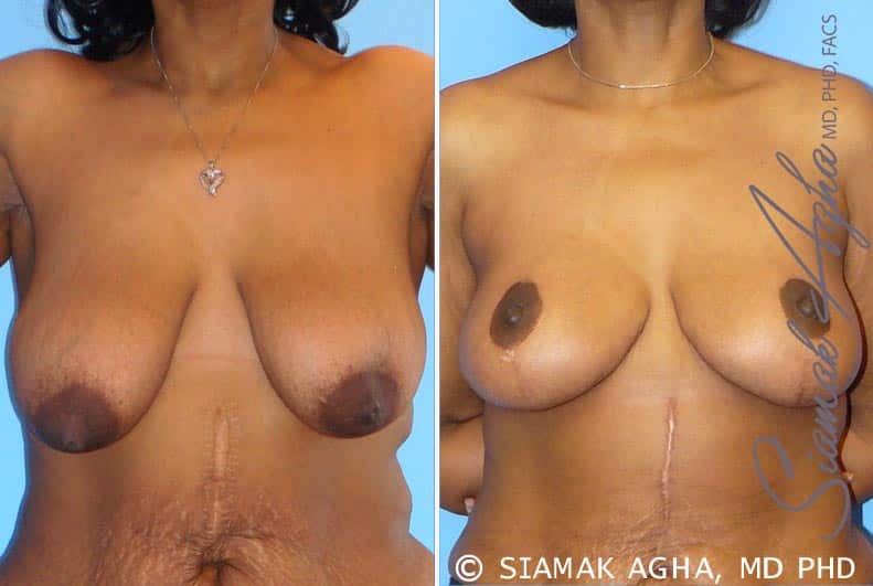Breast Lift Patient 1