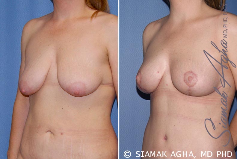 Breast Lift Patient 5