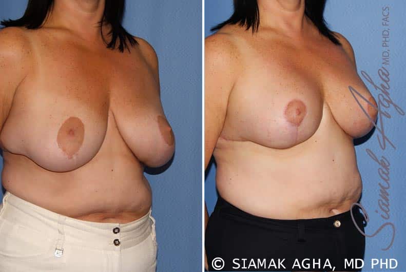 Breast Lift Patient 6