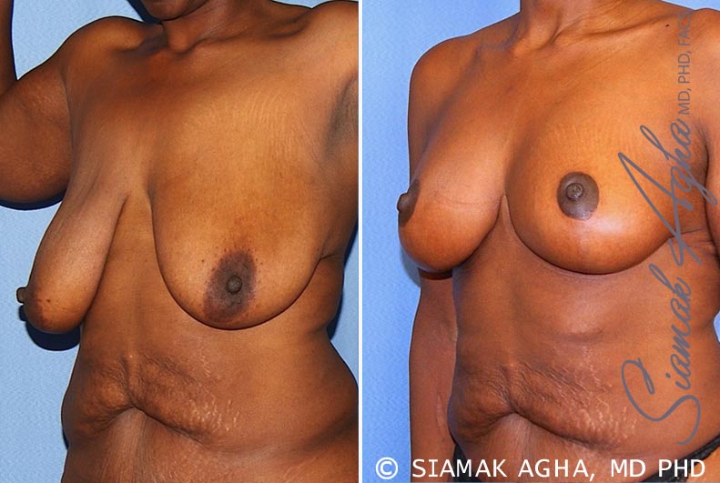 Breast Lift Patient 8